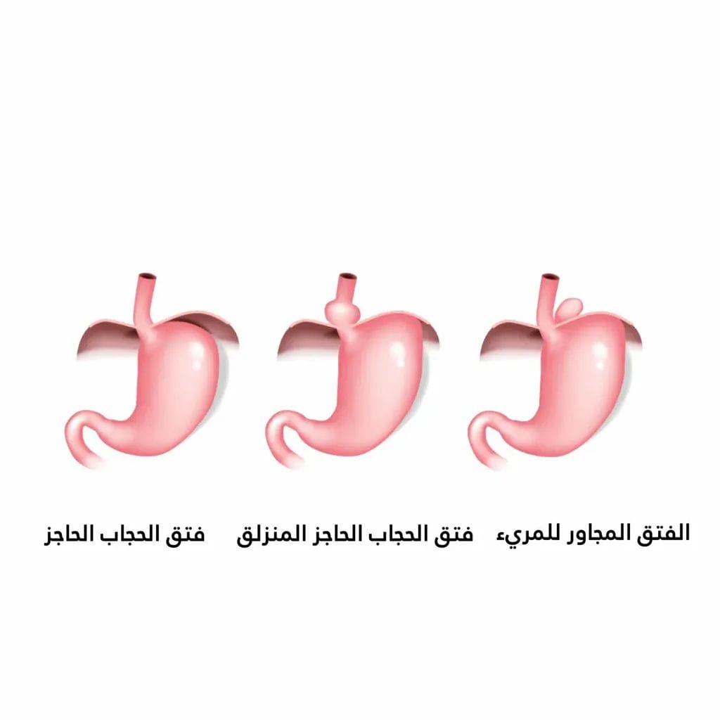 هل يلتئم فتق الحجاب الحاجز | دكتور محمد كريم عاشور 1 انواع فتق الحجاب الحاجز
