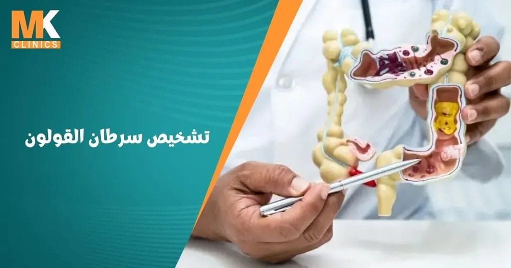 تشخيص سرطان القولون