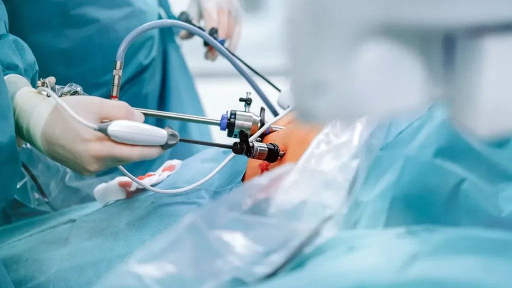 علاج السمنة المفرطة بدون جراحة: التخلص من السمنة نهائياً 2 تكميم المعدة بالمنظار