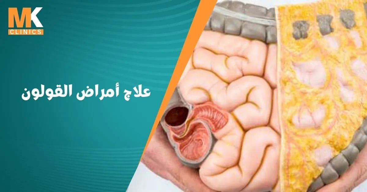 علاج أمراض القولون