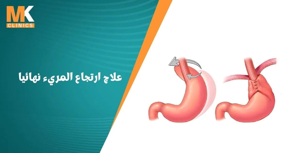 علاج ارتجاع المريء نهائيا