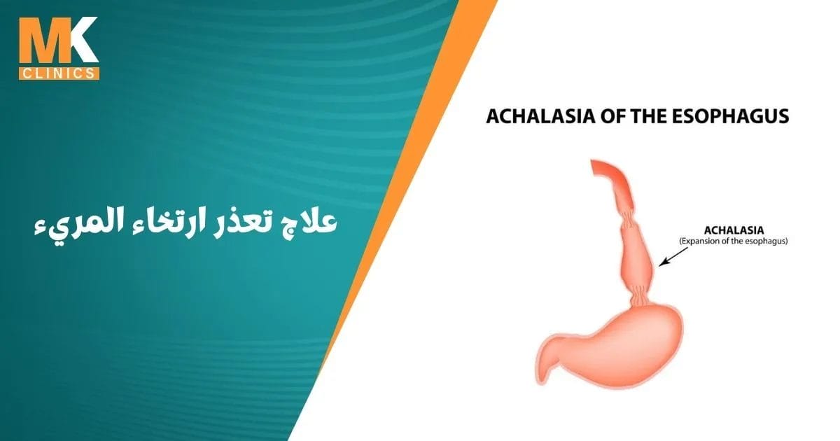 علاج تعذر ارتخاء المريء