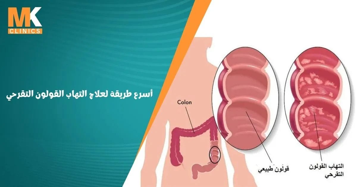 أسرع طريقة لعلاج التهاب القولون التقرحي