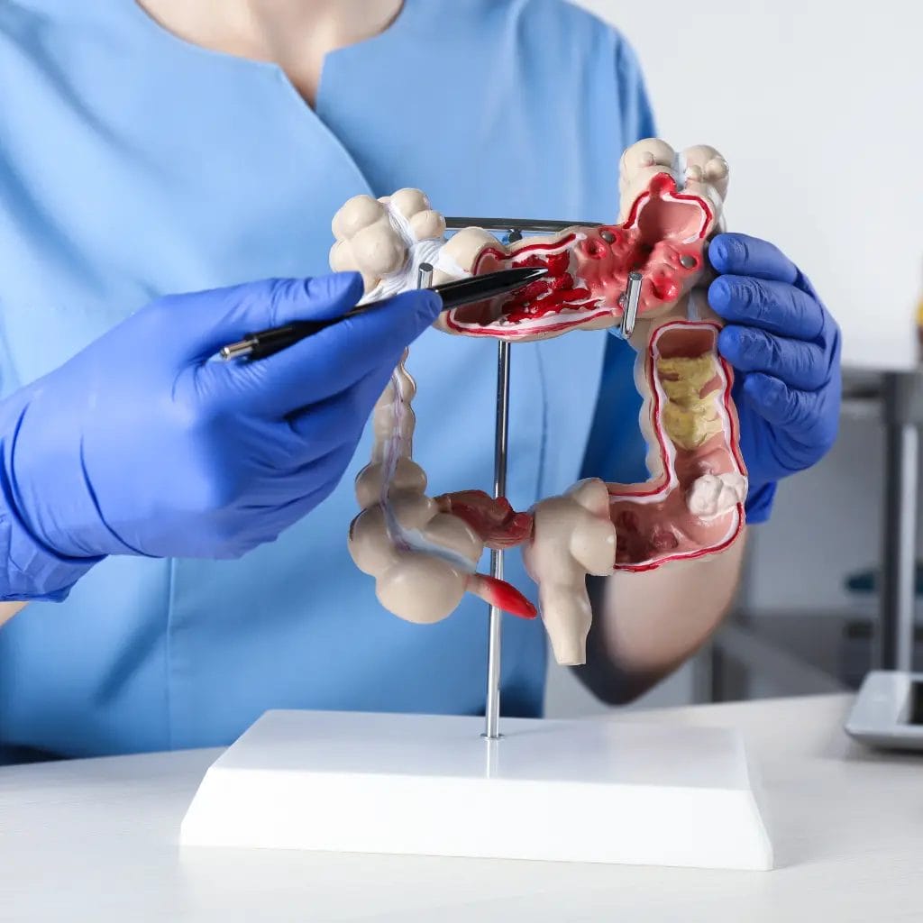 أفضل دكتور لعلاج القولون التقرحي