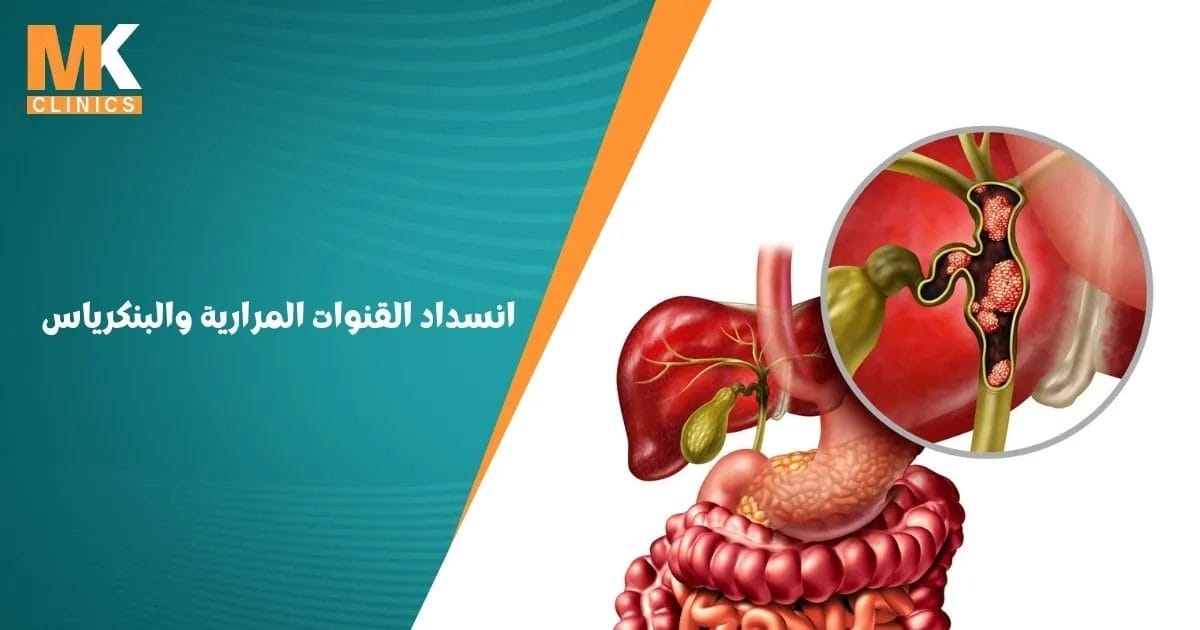انسداد القنوات المرارية والبنكرياس