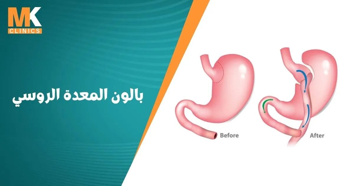 بالون المعدة الروسي