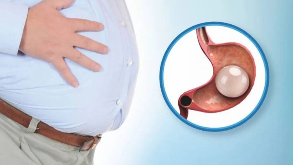 تجربتي مع بالون المعدة الروسي 