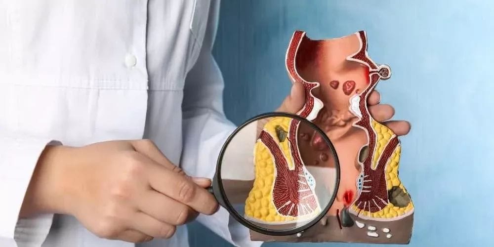 تكلفة عملية ربط البواسير بالمنظار | دكتور محمد كريم عاشور 5 تشخيص البواسير