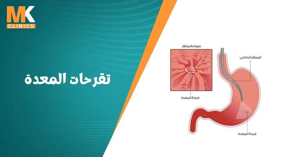 تقرحات المعدة