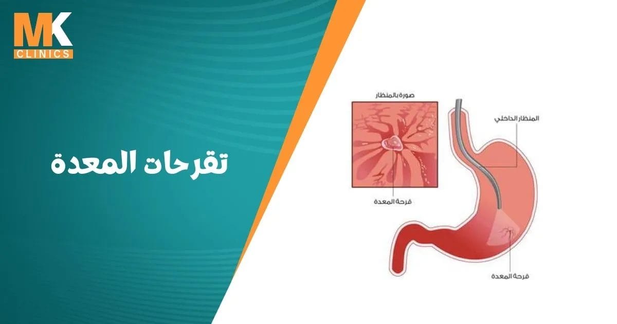 تقرحات المعدة