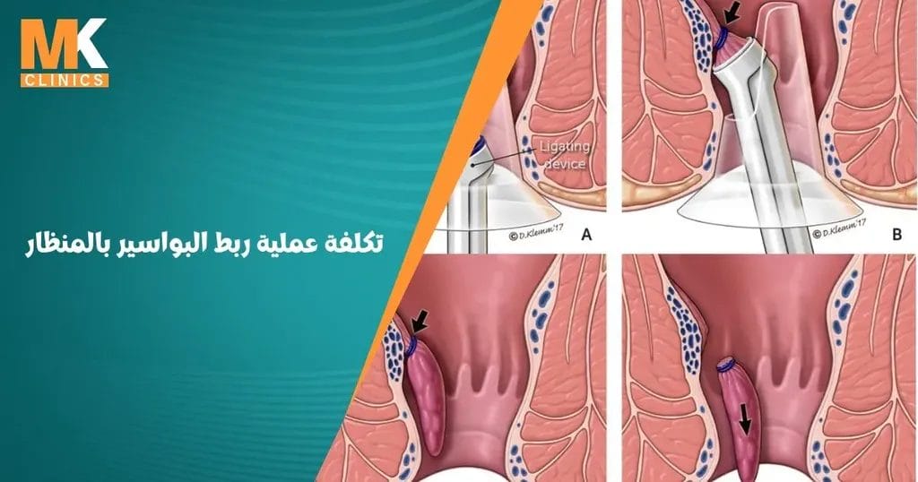 تكلفة عملية ربط البواسير بالمنظار