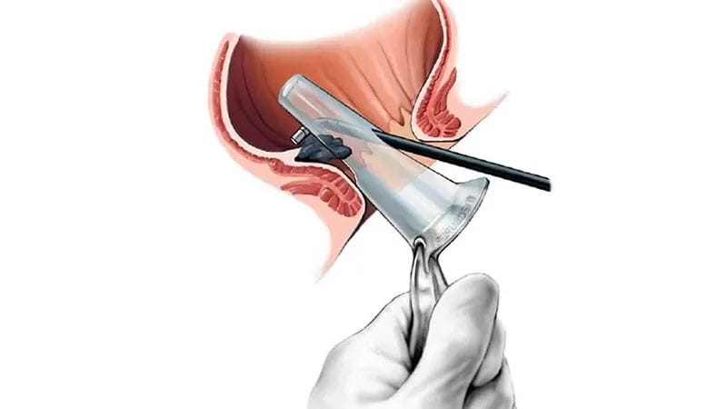 تكلفة عملية ربط البواسير بالمنظار | دكتور محمد كريم عاشور 1 سعر عملية البواسير بالليزر في مصر