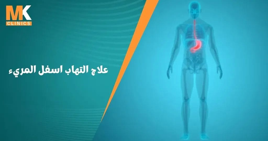 علاج التهاب اسفل المريء