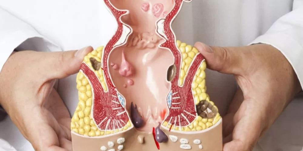 تكلفة عملية ربط البواسير بالمنظار | دكتور محمد كريم عاشور 4 عملية ربط البواسير الخارجية