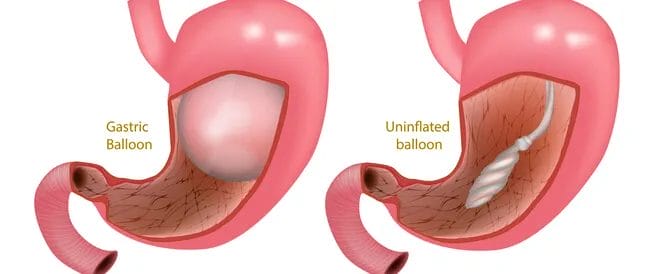 مميزات وعيوب بالون المعدة الروسي