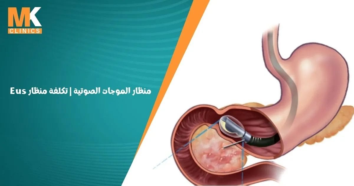 منظار الموجات الصوتية ما هي تكلفة منظار Eus ؟
