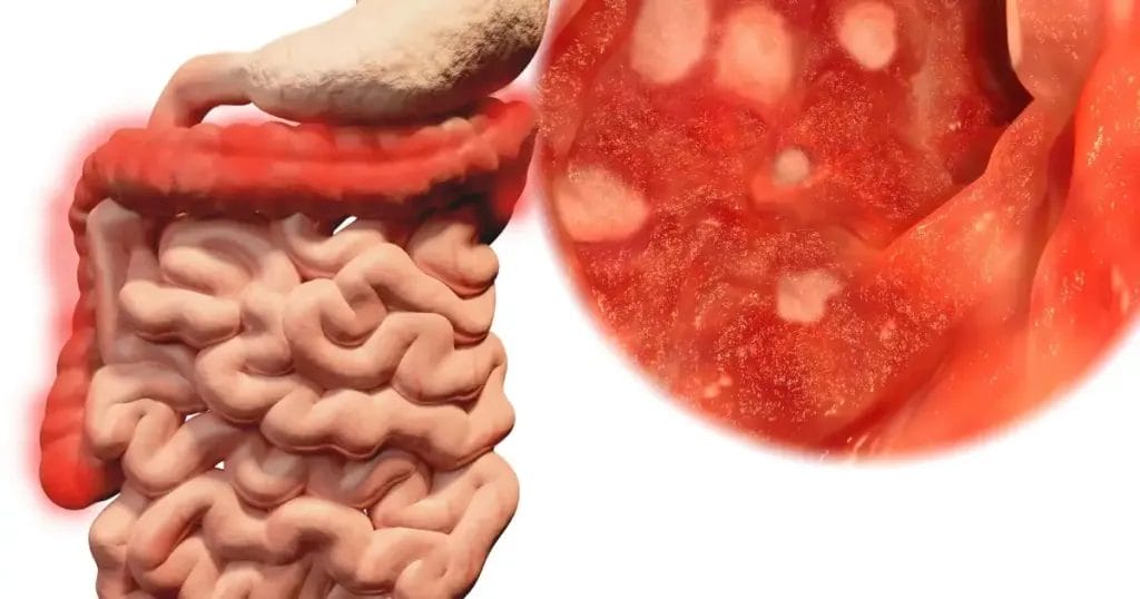 هل القولون التقرحي مرض مناعي