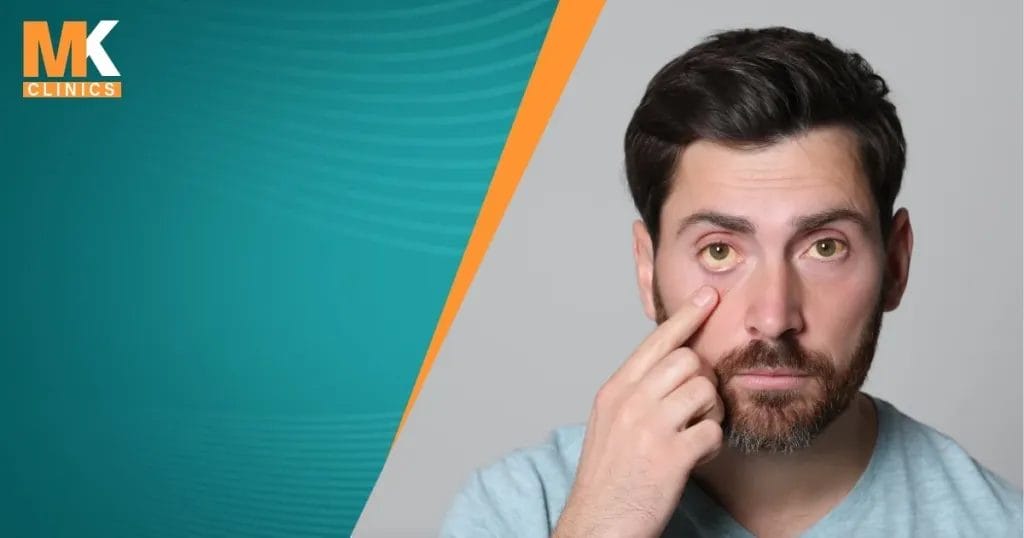 أسباب ارتفاع الصفراء غير المباشرة