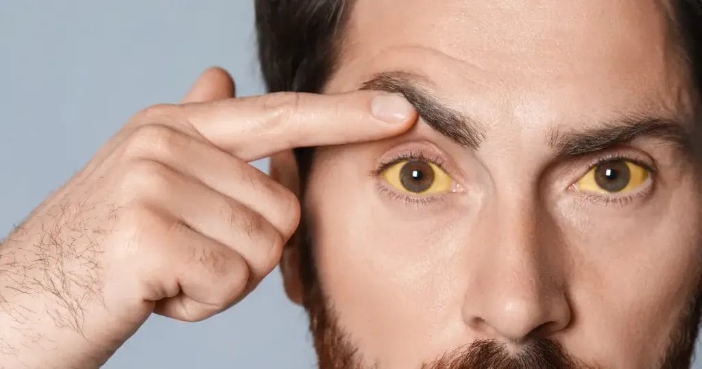 أسباب ارتفاع الصفراء غير المباشرة 