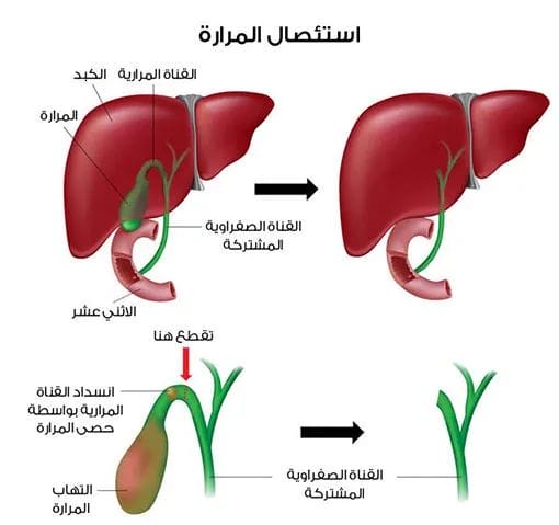 اعراض توسع القناة المرارية | هل توسع القناة المرارية خطير ؟ 1 توسع القناة المرارية بعد استئصال المرارة