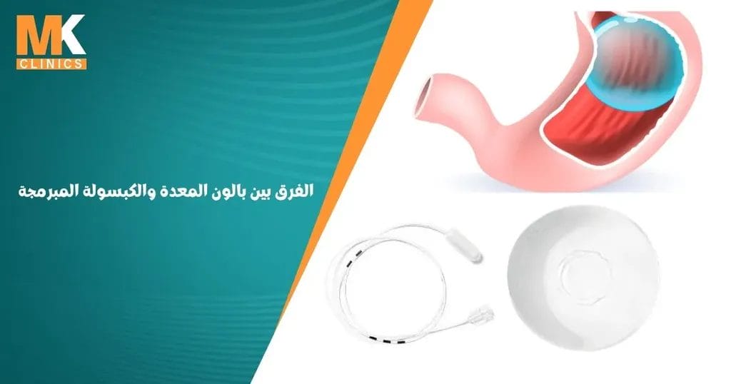 الفرق بين بالون المعدة والكبسولة المبرمجة
