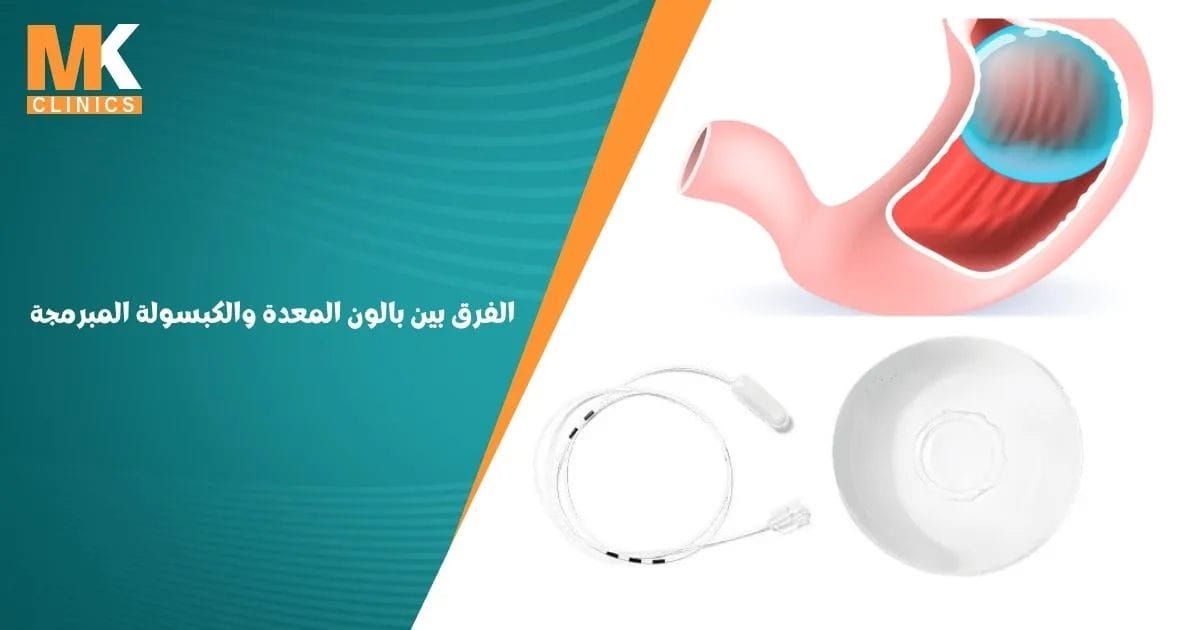 الفرق بين بالون المعدة والكبسولة المبرمجة