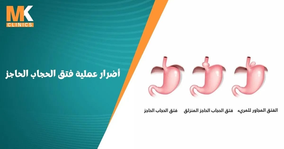 أضرار عملية فتق الحجاب الحاجز
