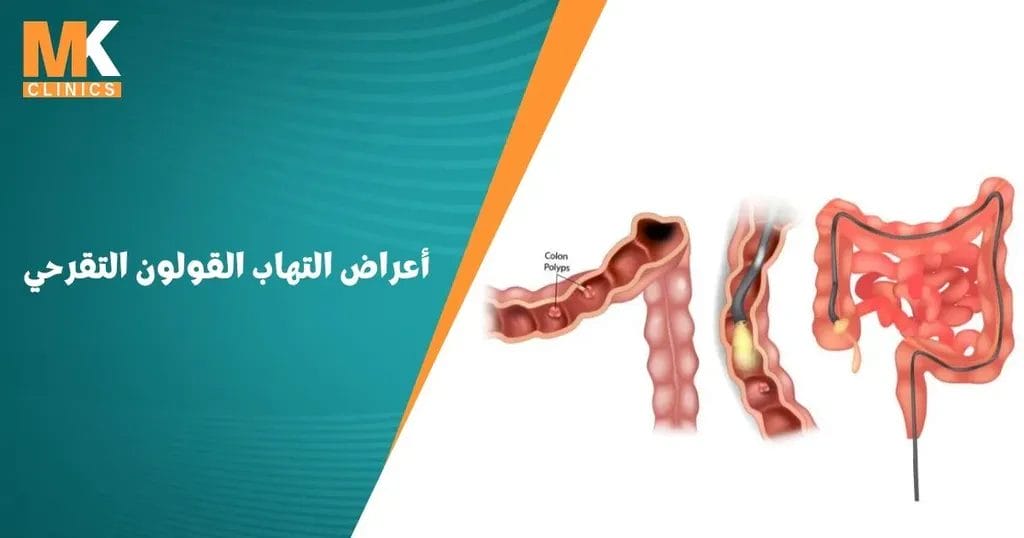 أعراض التهاب القولون التقرحي