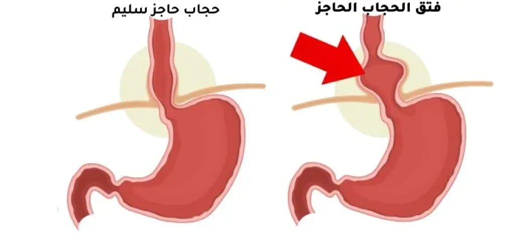 أفضل جراح فتق في مصر