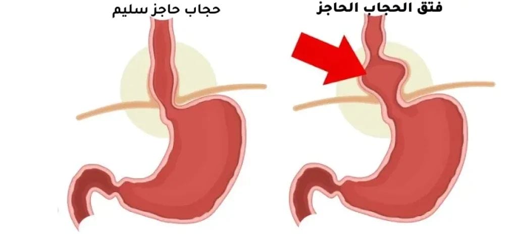 اكتشف الأن أبرز أضرار عملية فتق الحجاب الحاجز وطرق الوقاية 3 أفضل جراح فتق في مصر