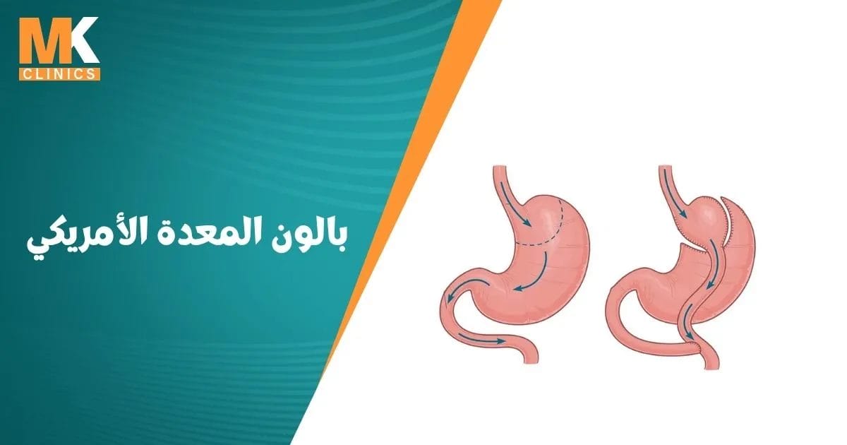 بالون المعدة الأمريكي