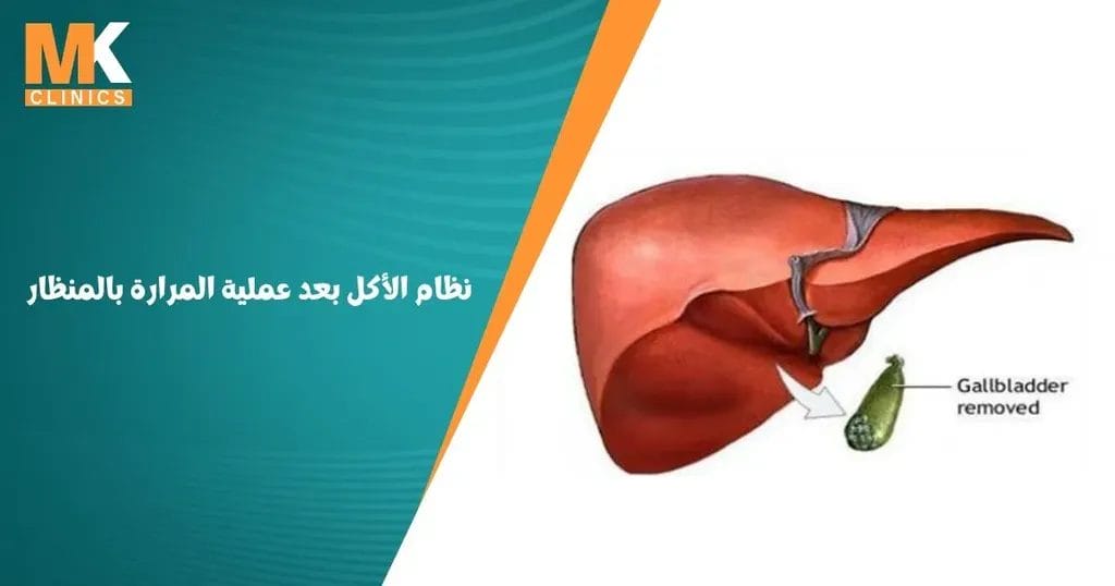 نظام الأكل بعد عملية المرارة بالمنظار