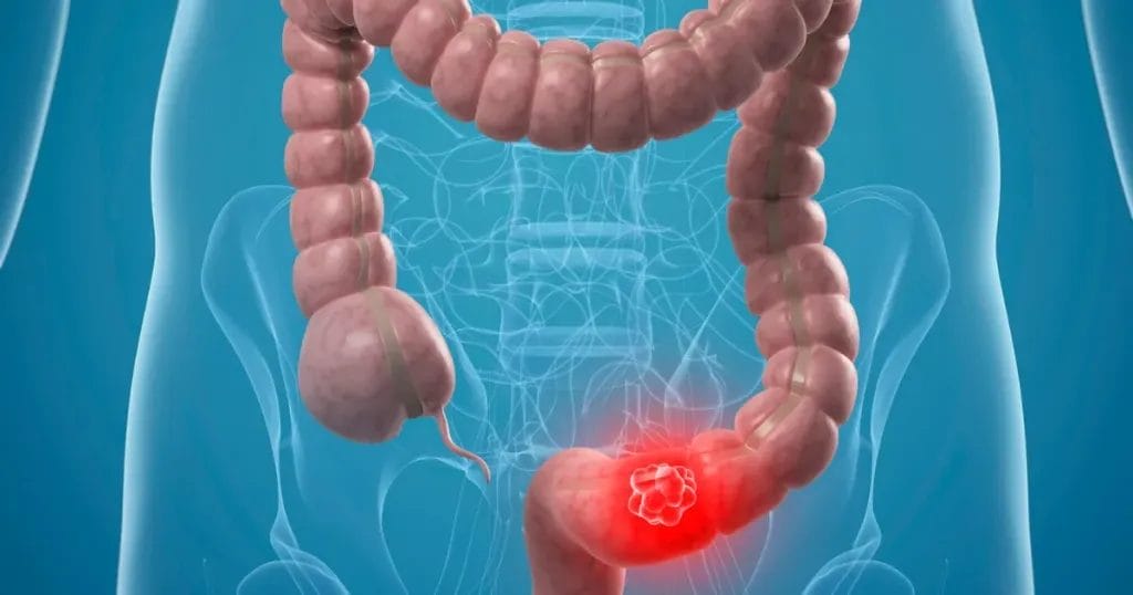 أسباب ظهور الزوائد اللحمية في القولون 