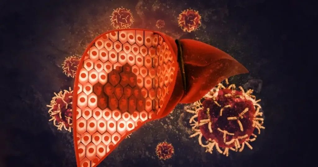 عوامل الخطورة للإصابة بسرطان الكبد عند النساء