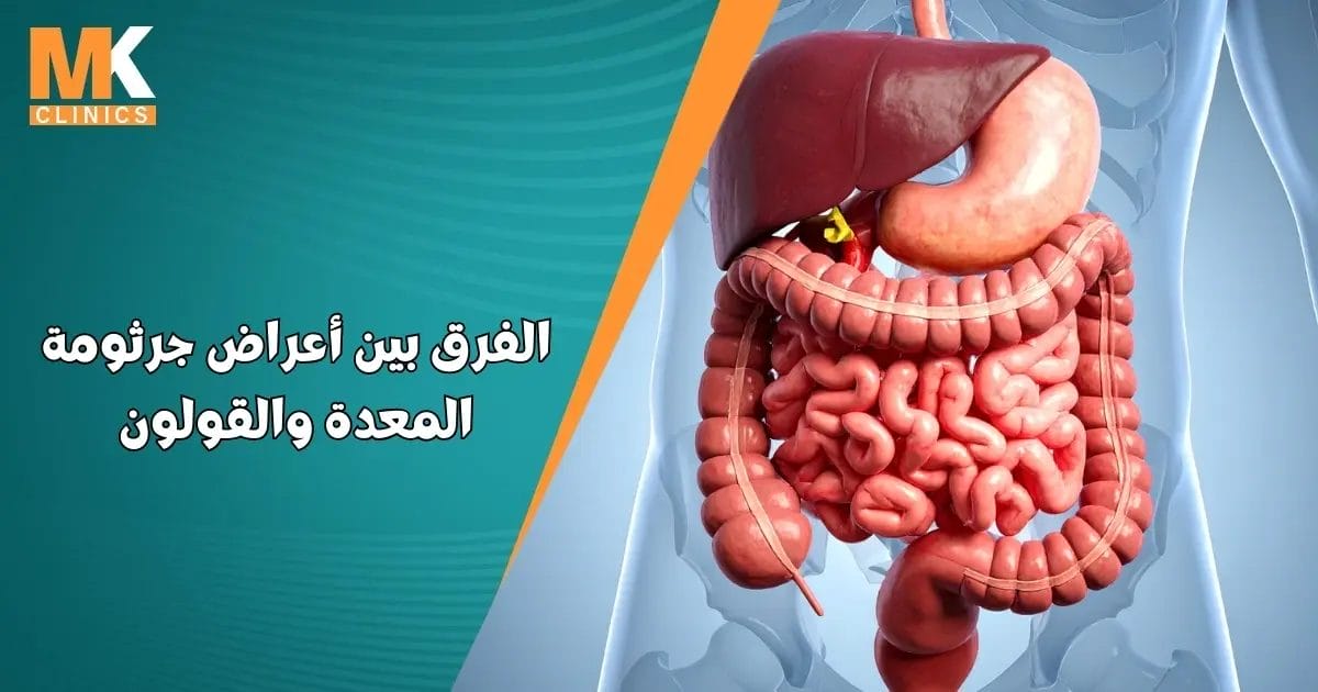 الفرق بين أعراض جرثومة المعدة والقولون
