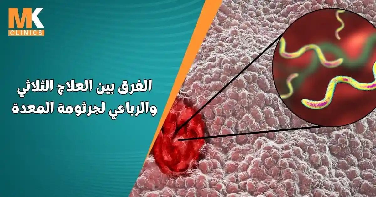 الفرق بين العلاج الثلاثي والرباعي لجرثومة المعدة