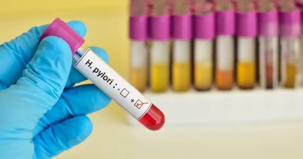 طرق تشخيص جرثومة المعدة بالمنظار
