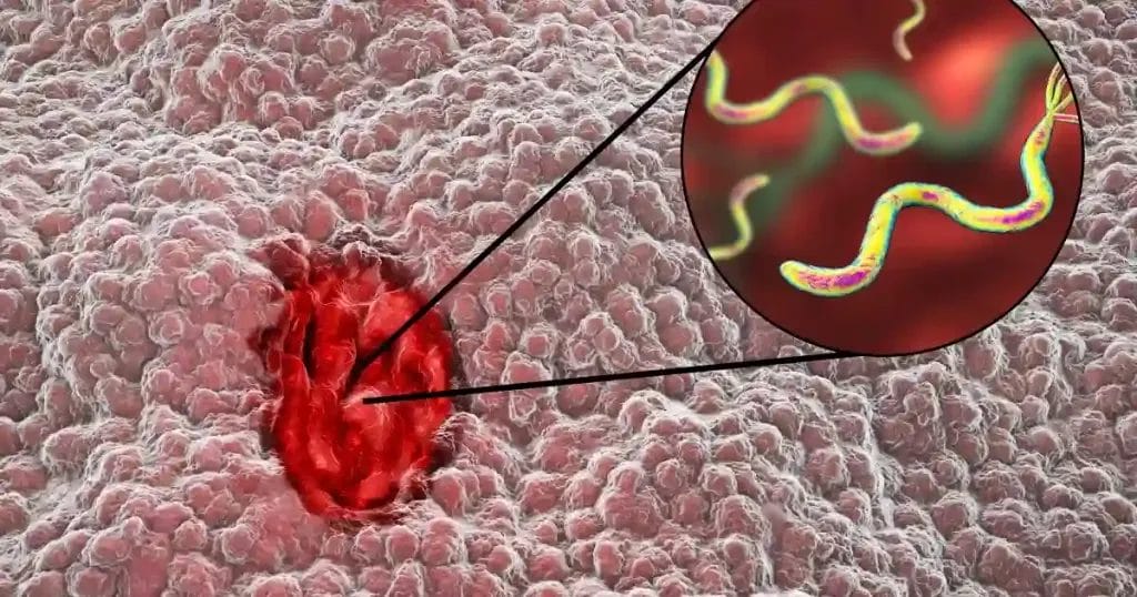 أعراض جرثومة المعدة الخطيرة