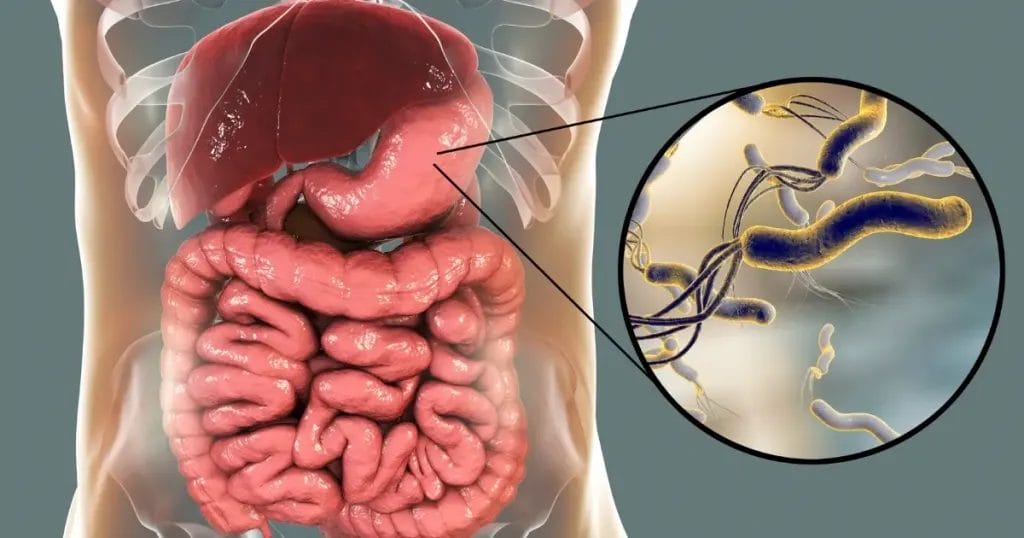 أعراض جرثومة المعدة النفسية