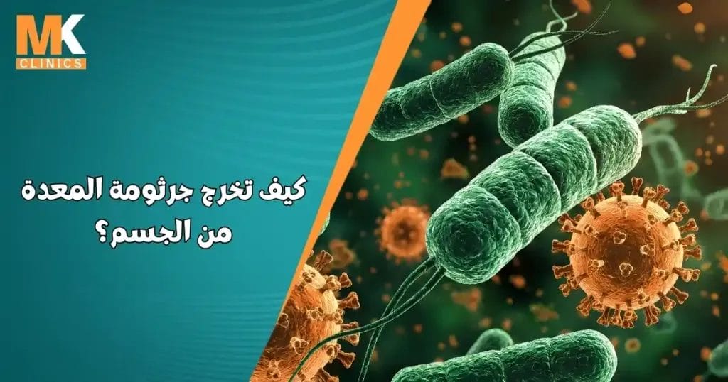 كيف تخرج جرثومة المعدة من الجسم