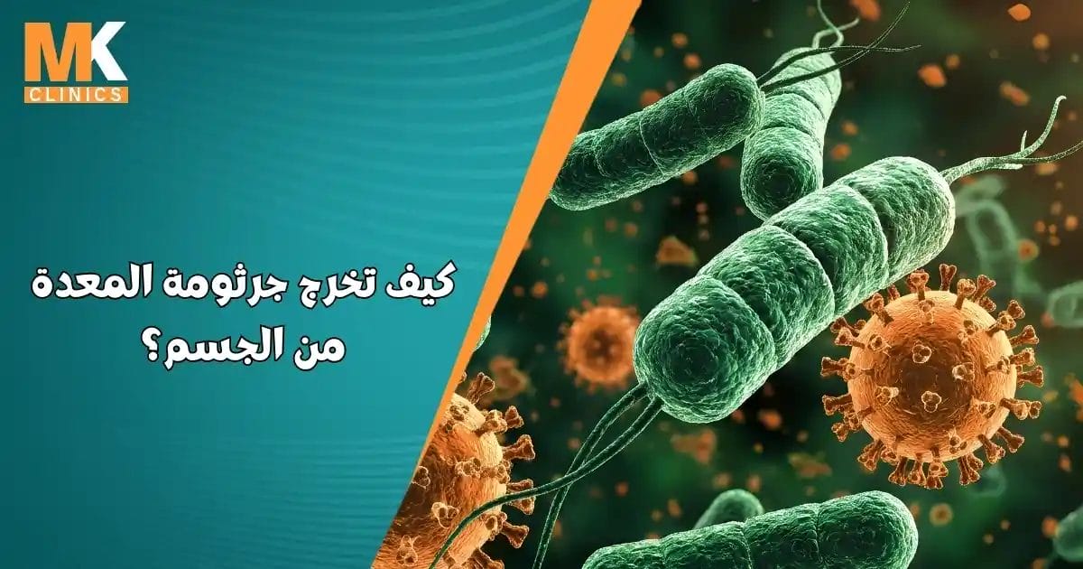 كيف تخرج جرثومة المعدة من الجسم