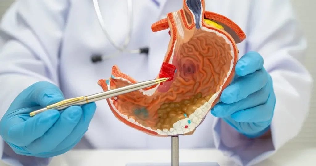 أعراض قرحة الاثني عشر
