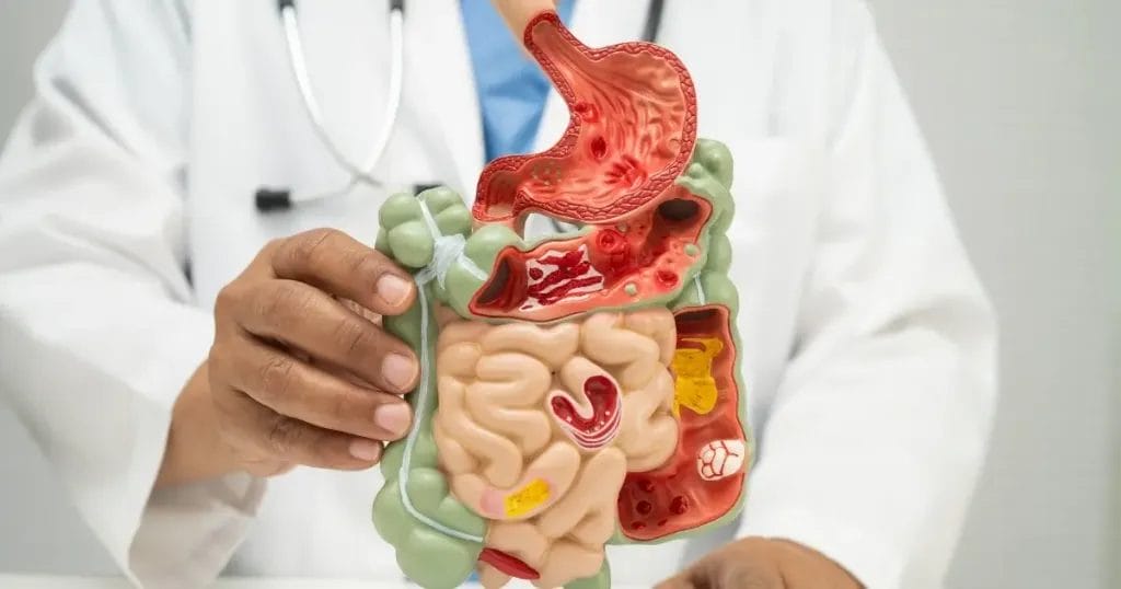 كيف شفيت من قرحة المعدة