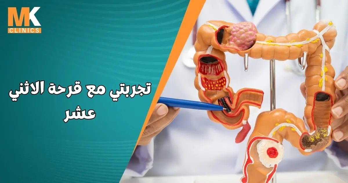 تجربتي مع قرحة الاثني عشر